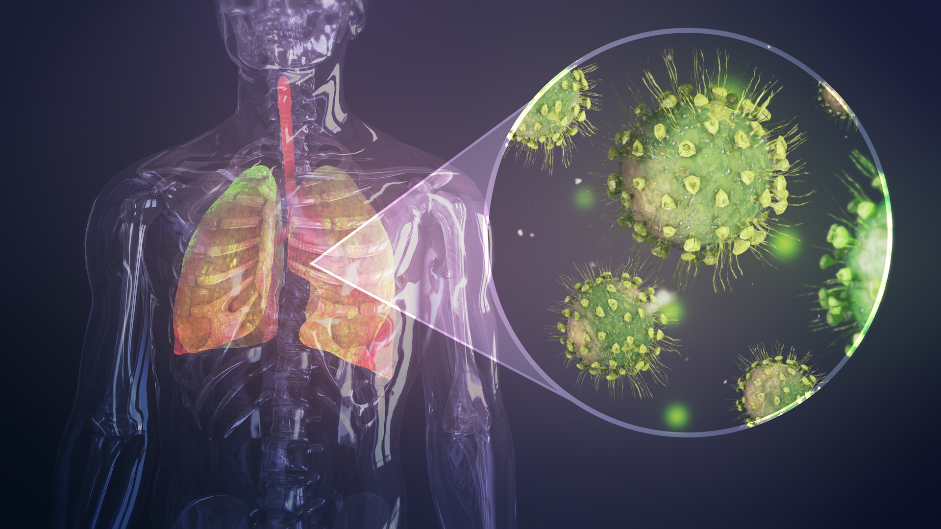 Respiratory disease inside lungs. Pneumonia. Coronavirus type virus as ...